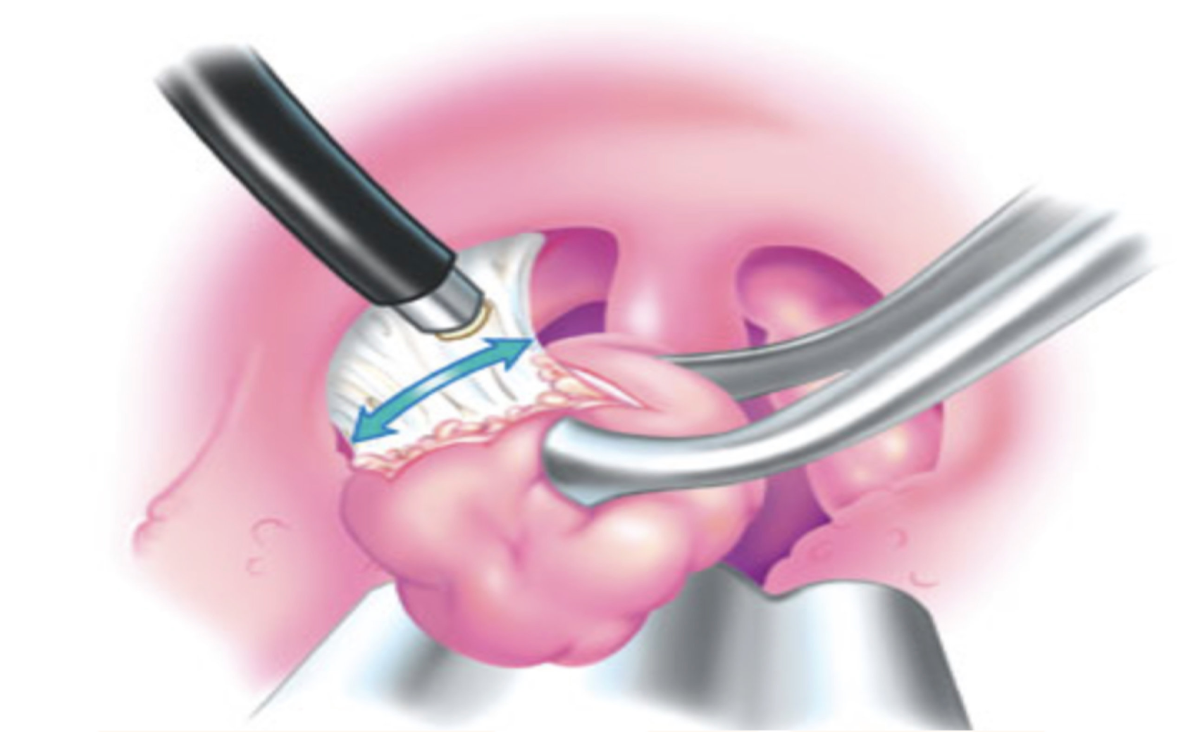 Tonsillectomy